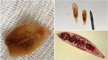 Oberste Parasiten in einer Person